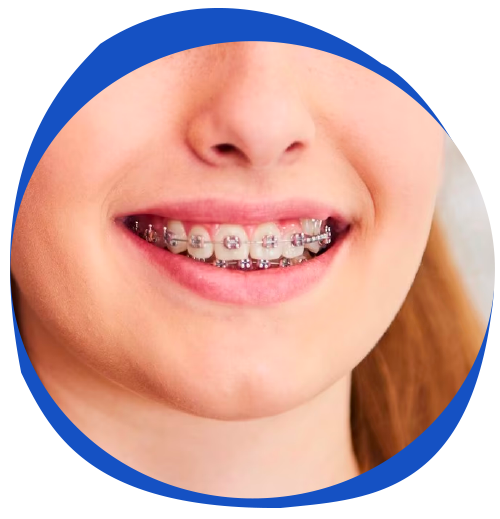 https://www.aimiljuniorsmiles.com/wp-content/uploads/2023/03/S1-Orthodonic-treatment-Braces.png